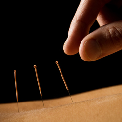top-acupuncture-services-in-doral-florida-shopping-guide